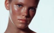 Natural treatments for acne and sunburn – The Beauty Biz
