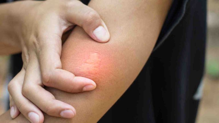 8 effective home remedies for bee sting