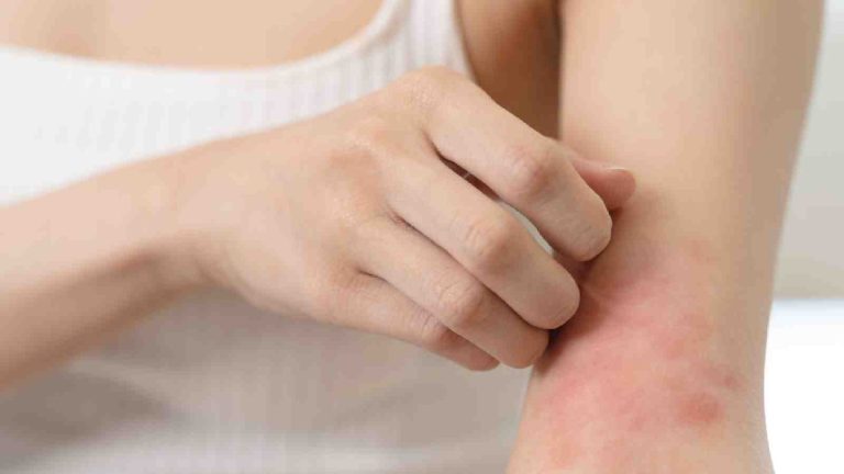 Heat rash treatment: Try the cooling benefits of coconut oil