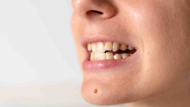 Loose teeth in adults: Find the cause and ways to fix it