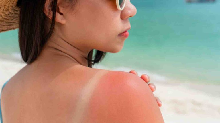 How to avoid sunburn? Try these 5 tips to prevent them