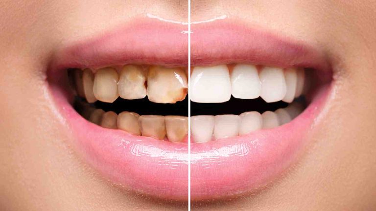 5 simple ways to get rid of tartar from teeth at home