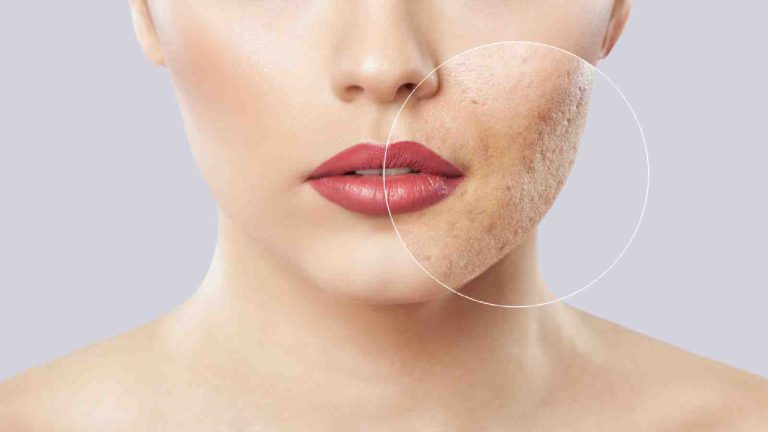 How to get rid of acne scars? Here are treatment options