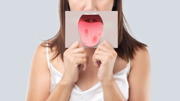 7 effective home remedies to heal a burnt tongue fast