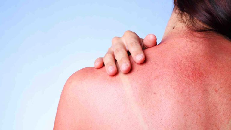 Skin care tips: 5 things to avoid while treating a sunburn
