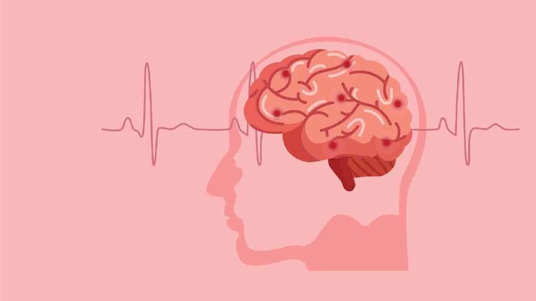 Stroke: Know the FAST signs and risk factors