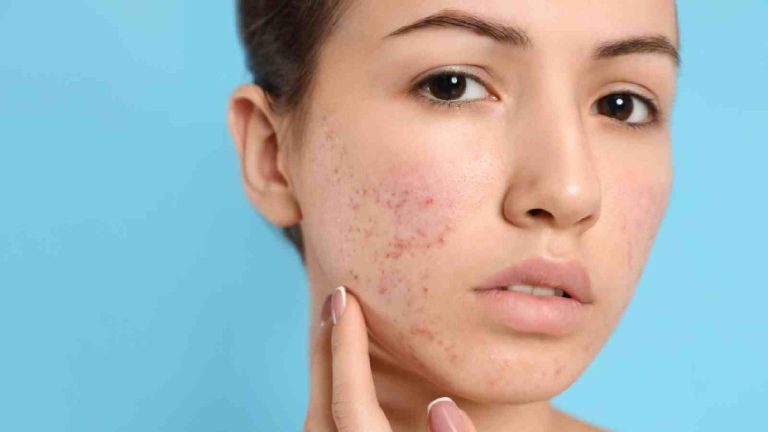 5 nutrients to avoid acne and breakouts during monsoon