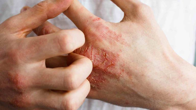 Psoriasis: Homeopathic remedies for treating the skin problem