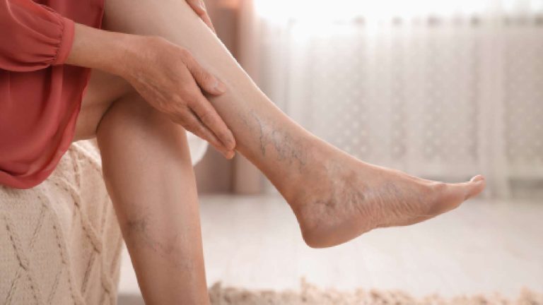 Top tips to deal with varicose veins pain