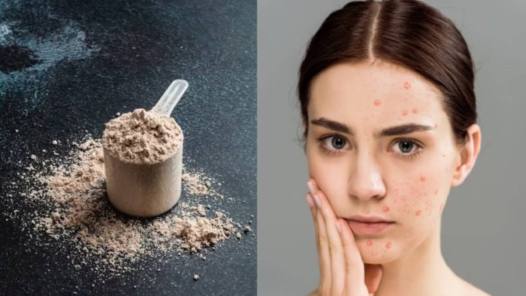 Whey protein side effects on skin: Can it cause acne?