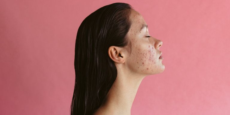 What Is Hormonal Acne and How Do I Get Rid of It?