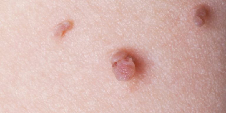 How to Remove Skin Tags the Right Way, According to Dermatologists