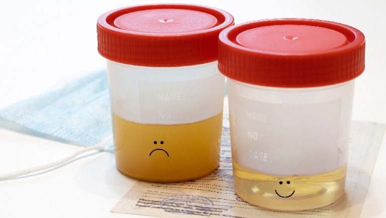 Causes and treatments of cloudy urine