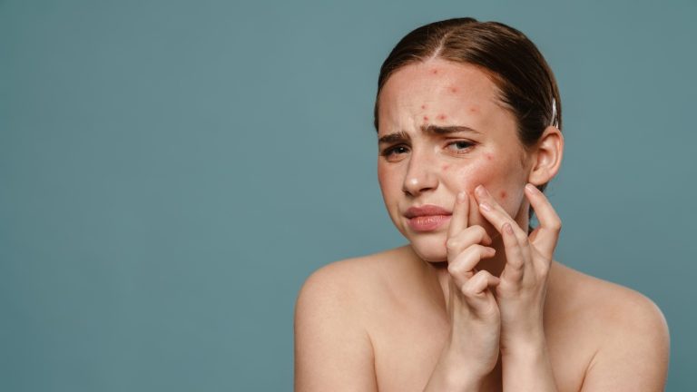 Winter acne breakouts: Causes and 11 tips to deal with it