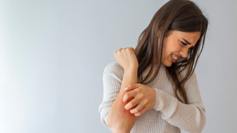 How to deal with psoriasis in winter: 7 expert tips