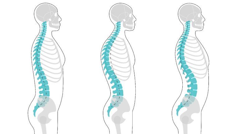 The Hidden Threats: How Poor Posture Poses a Risk to Your Health