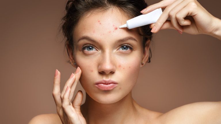 6 tips to get rid of forehead acne