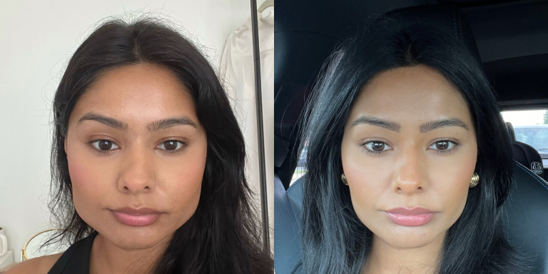Is Masseter Botox Worth It? We Asked 8 People for Their Honest Reviews