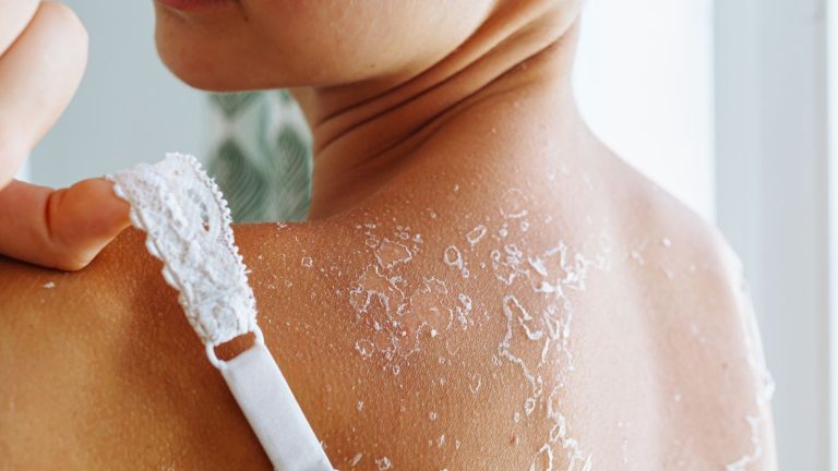 6 effective home remedies for peeling sunburn
