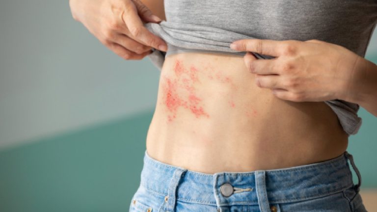 Shingles: Symptoms, causes, complications and treatment