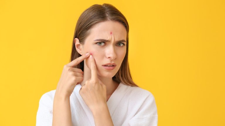 Acne: Types, symptoms, causes, treatment, prevention and more