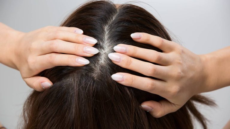 7 tips to manage excessive scalp sweating