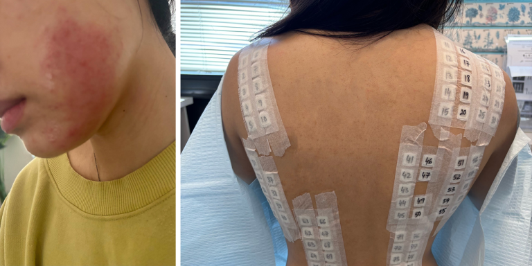 Here’s What Getting a Skin Patch Test Is Really Like