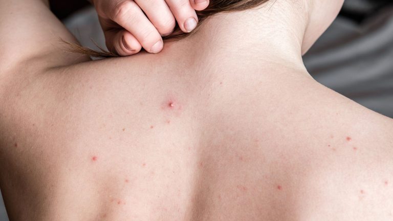 5 home remedies to manage back acne during periods