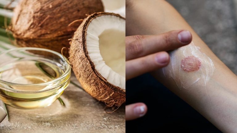 Coconut oil may be the best home remedy for ringworm