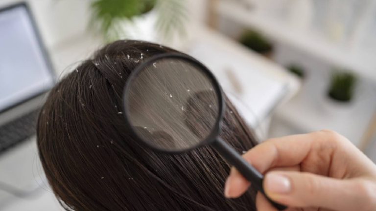 Dandruff: What is it, Causes, Treatment and Prevention Tips