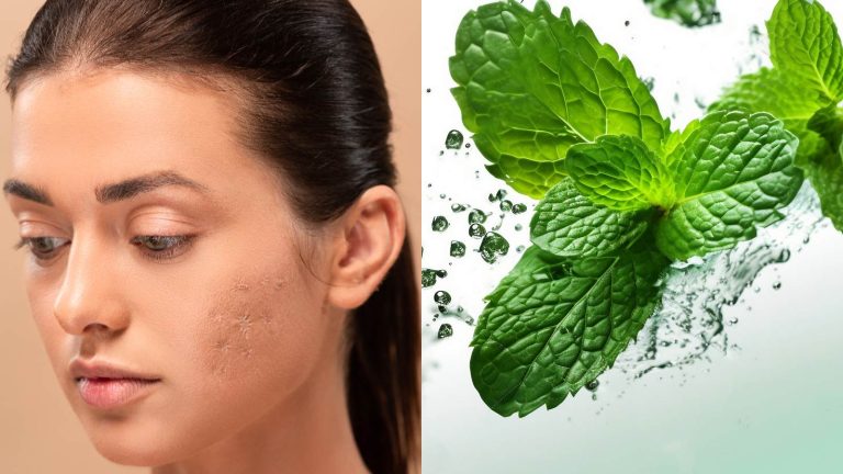 5 simple ways to use mint leaves to reduce acne scars