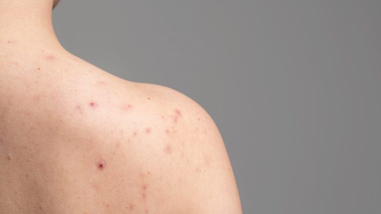 Shoulder acne: Causes and home remedies