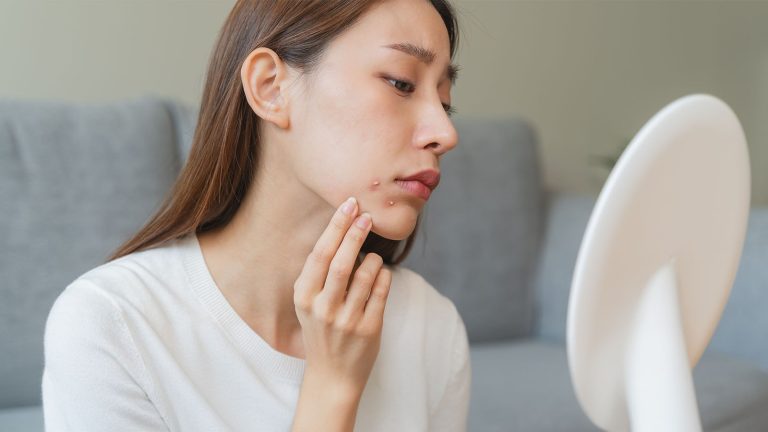 How to deal with period acne? 12 tips to follow