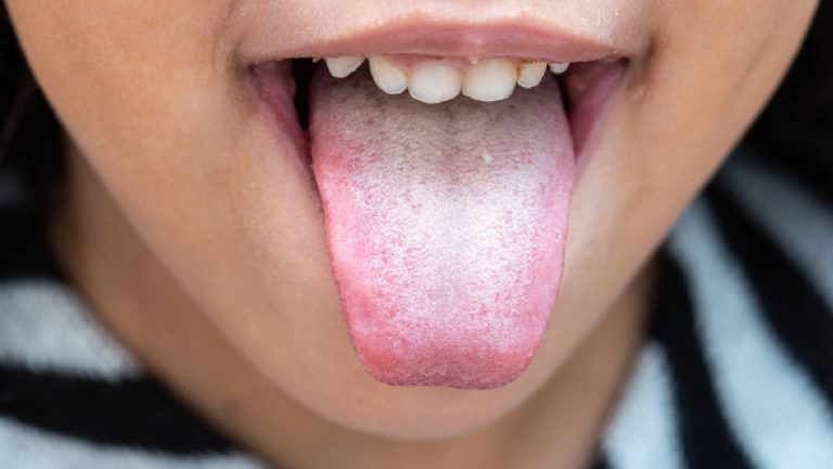 Oral thrush: What is it, symptoms, treatment