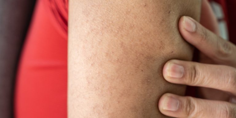 3 Things That Will Actually Help Treat Keratosis Pilaris—And 3 That Won’t