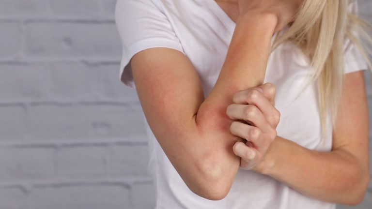 5 home remedies for eczema you must try!